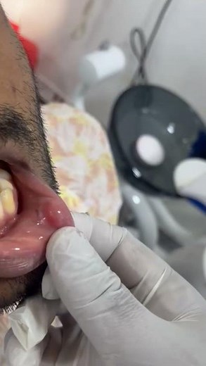 surgical removal of mucocele in lower lip