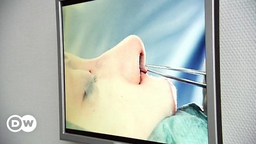 Complications from a Nasal Fracture