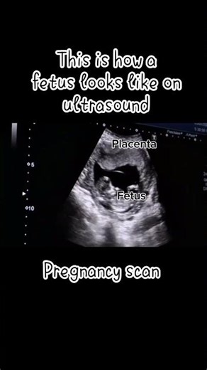 This is how a fetus looks like on ultrasound #ultrasound #pregnancy #baby #fetus #radiology #obs