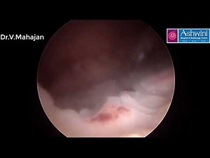 Hysteroscopic polypectomy & directed curettage using TruClear HTRS