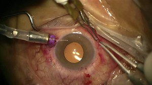 27-Gauge Pars Plicata Vitrectomy and Intrascleral Fixation for Intraocular Lens Dislocation - Eyetube