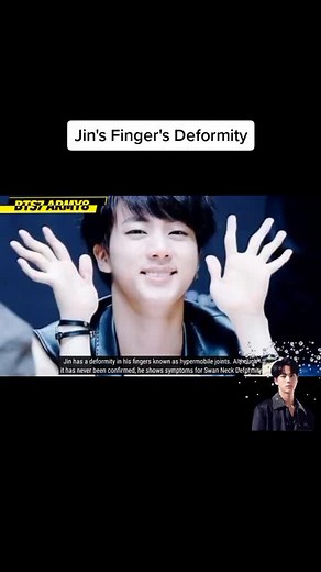 Understanding Jin's Finger Deformity: Exploring BTS Jin's Unusual Fingers