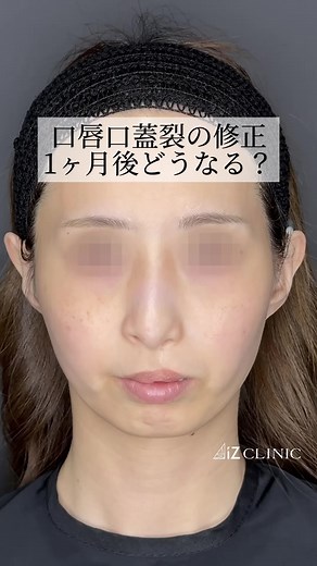 口唇口蓋裂修正手術と鼻整形の経過