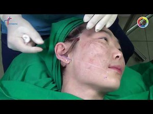 Cheek Lifting Technique with PDO thread | N-cog Royal & N-Cog Spiral