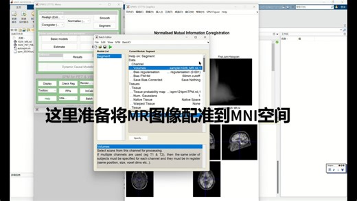 使用SPM12配准PET图像