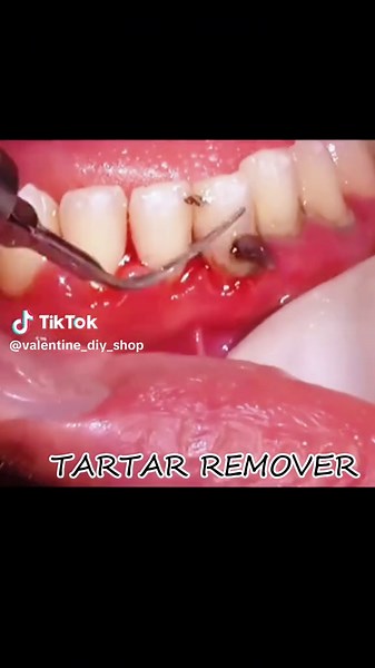 Plaque/Tartar Remover for Teeth,Dental Calculus Remover Teeth... #tartarremover #tartarremovalcleaning #deepcleaningteethprocedure #deepcleaningteethprocedure