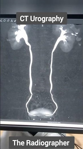 CT Scan Urography | #ivu #kidney #kub #ureter #bladder #kidneystone