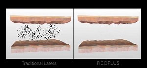 19K views · 240 reactions | PICO PLUS laser | 皮秒镭射 An award winning...