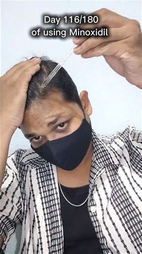 Minoxidil Day 116 | Hair Regrowth Progress Update 😳 #minoxidil #minoxidilresult #hair