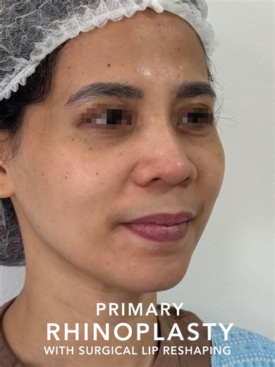 1 month before & after ✨ Subtle changes, thoughtful shaping. Primary rhinoplasty paired with surgical lip reshaping for softer balance and facial harmony. #Rhinoplasty #LipReshaping #RhinoplastyPhilippines #MerakiEsthetique