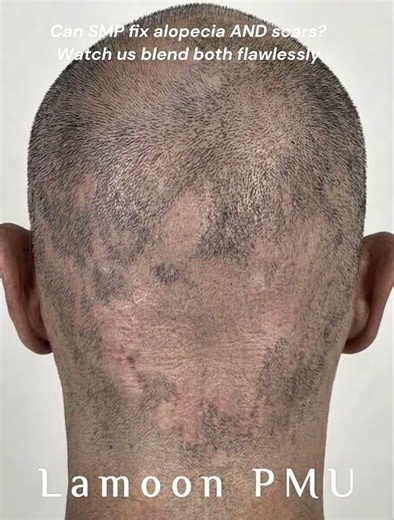 Fixing Alopecia and Head Scars with Scalp Micropigmentation (SMP)