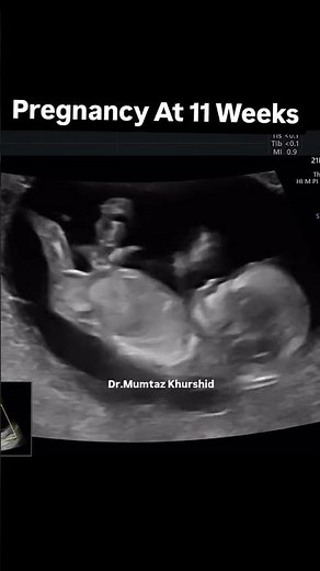 11 Weeks Pregnancy On Ultrasound Scan