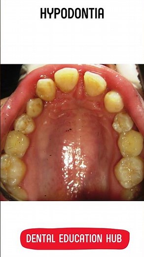 HYPODONTIA | Missing Teeth