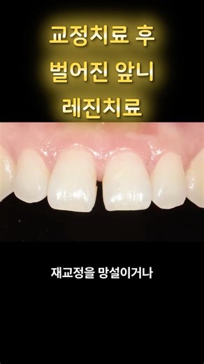교정 후 다시 벌어진 앞니, 재교정 없이 치아 보존하며 당일 복원하는 법 #벌어진앞니 #앞니레진 #레진빌드업