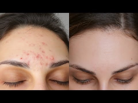 BENZOYL PEROXIDE FOR ACNE ❤️ Step-by-Step Guide on HOW TO USE IT Without SIDE EFFECTS