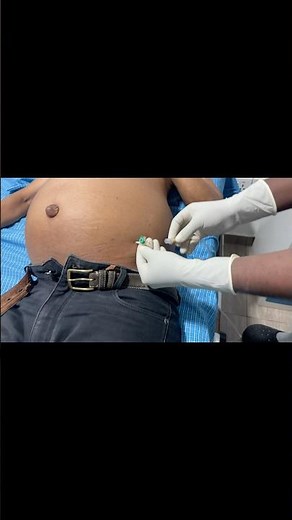Abdominal Tap #ascites