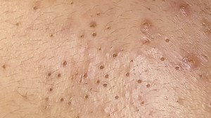 Popping a Giant Blackheads on the Face