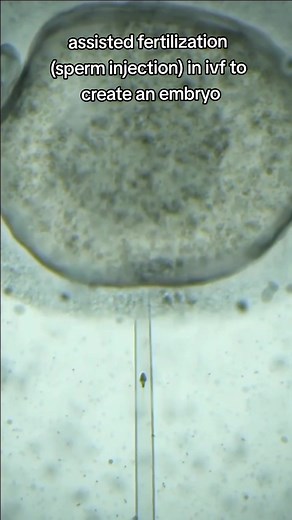 sperm injection or icsi revolutionized ivf to overcome human infertility #ivf #infertility #ttc #icsi #foryour #yourpage #xyzbca video cred sk_beats_editor