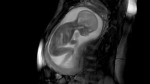 Breathtaking new 20-week MRI scan from London’s iFIND project lets expectant parents watch their unborn babies wiggle, swallow and even pull on the umbilical cord – FOUR WEEKS before the upper limit for most UK abortions! https://goo.gl/SfYMI6 | Right To Life UK