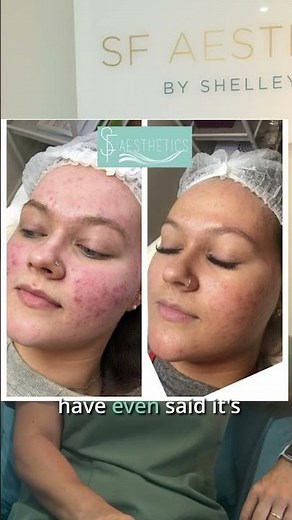 Microneedling For Acne Scars: What It Can And Can't Fix
