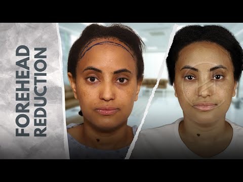 Female Hairline Lowering Surgery | Forehead Reduction Before & After #ForeheadReduction