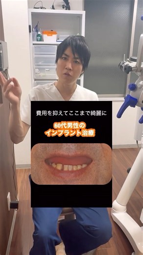 Full-Mouth Implant Case for a Patient with Loose Upper and Lower Teeth #dentist #implant #Omiya I...