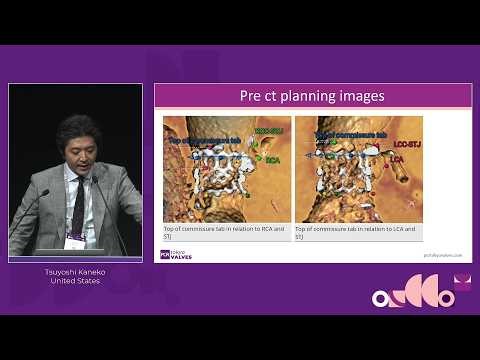 Learn from the experts: lifetime management for Evolut first redo TAVI (TAV-in-TAV) and explant