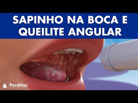 SAPINHO na boca (candidíase) e QUEILITE angular - TRATAMENTO de fungos na boca ©