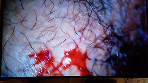 File:Verrugas o granitos en VULVA O VAGINA.webm - Wikimedia Commons