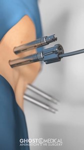 645K views · 1.8K reactions | Spineology’s Pedicular Fixation device, Threshold, ensures secure implant-to-instrumentation connections with a forward thinking screw desi | The Visual Surgery | Facebook
