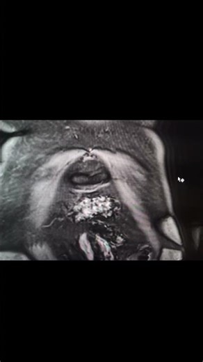 MRI post contrast liver lesions in IV segment #mri #pathology