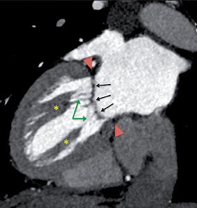 Valve mitrale - Chirurgie cardiaque - Clinique Saint-Augustin, Bordeaux