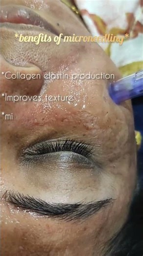 #stepbystepmicroneddling #microneddling#microneddling #meso serum