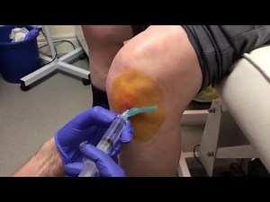 Norwich Podiatrist - Ostenil Plus injection of knee - part 1