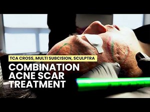 How to Treat Deep Acne Scars: TCA Cross, Subcision, Excision, CO2 Laser, Erbium Laser, Sculptra