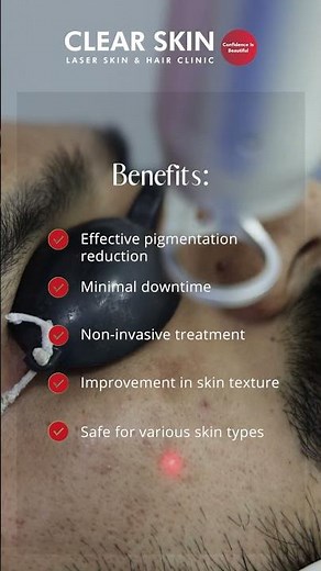 Q-Switch Laser for Melasma: Transform Your Skin with This Treatment | Clear Skin