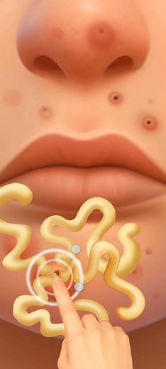 34K views · 212 reactions | Most Satisfying Pimple Pop Ever!  #Satisfying #PimplePop #OddlySatisfying #ViralShorts #TrendingNow #RelaxingVideos #ShortsFeed #PimplePopper #ASMRVideo #SatisfyingVideo | ASMR | Facebook