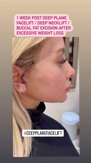 Dr Sam Rizk | 28 yo 1 week after deep plane facelift / necklift and Buccal fat reduction . Patient had lost over 100 lb and felt everything sagging . Dr... | Instagram