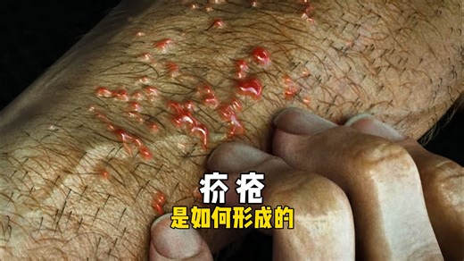 皮肤上你不知道的小秘密，疥疮是如何形成的