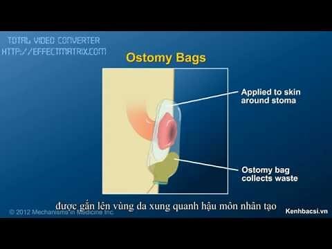 Phẫu thuật tạo hậu môn nhân tạo bằng mở thông hồi tràng