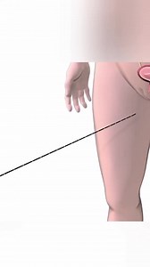 Kidney Stone Removal Procedure Explained