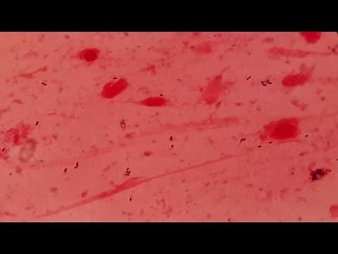 Sputum under the microscope showing Gram positive diplococci ।।Pneumococcus and plenty of pus cells