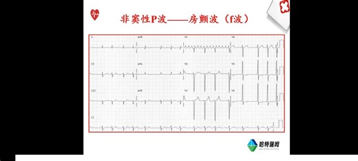 窄QRS波鉴别诊断