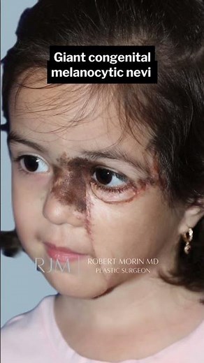 Pediatric Patient’s Journey: Overcoming Giant Melanocytic Congenital Nevus