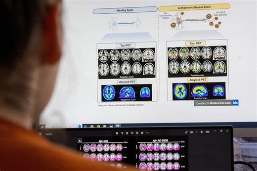 Researchers able to predict common form of dementia with AI