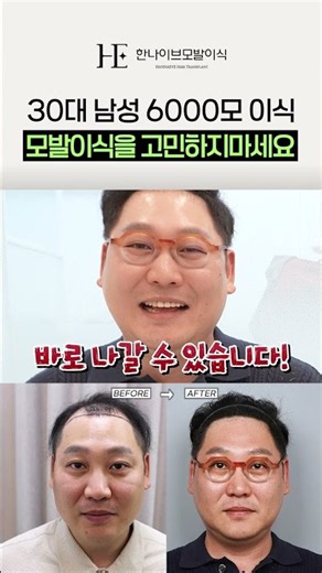 모발이식 만족도 100%