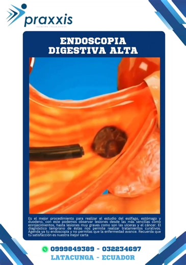 La endoscopia digestiva alta permite evaluar esófago, estómago y duodeno con precisión. En Praxxis realizamos diagnósticos seguros y confiables. #medicocirujano #endoscopiadigestiva #SaludYCuidado #praxxis #Latacunga | Praxxis