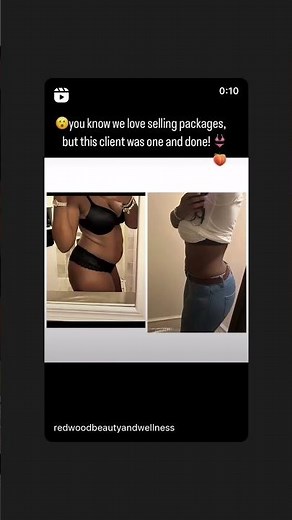 24 hour results from our non-invasive body contouring! Let’s get it people