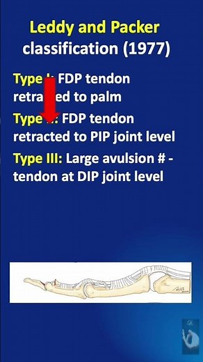 Shorts # 153: Classification of FDP avulsion injuries- Jersey finger - Leddy & Packer Classification
