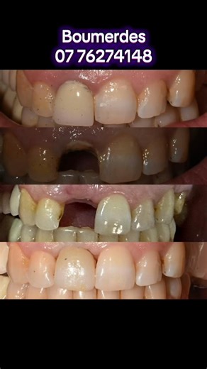 Remplacer une dent perdue , surtout en antérieur est un vrai challenge Pour allier esthesthique et fonction on a que l’implant dentaire pour restaurer les tissus avoisinants sans perte dentaires #boumerdes_35 #dentista #chirurgiendentiste #tizi_ouzou_boumerdes_bouira_bejaya #جزائر